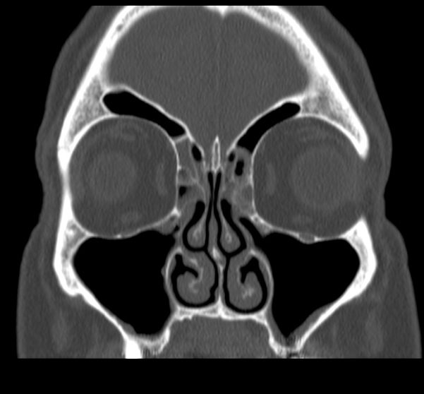 Acute sinusitis (Radiopaedia 23161-23215 Coronal bone window 30).jpg