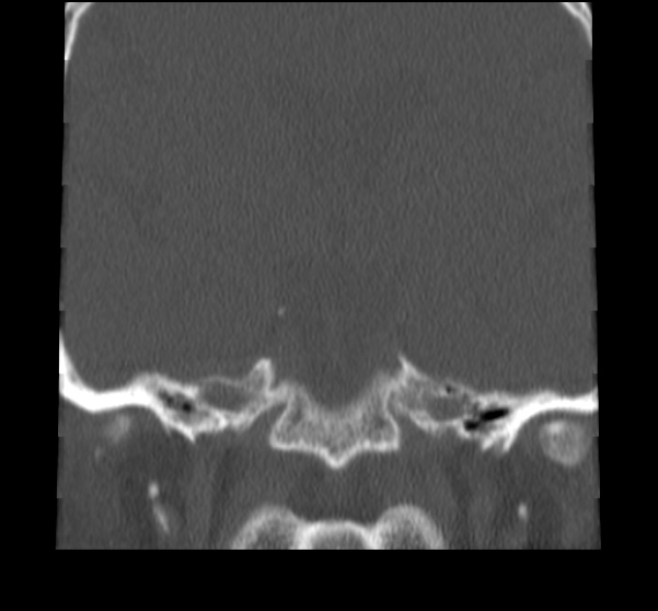File:Acute sinusitis (Radiopaedia 23161-23215 Coronal bone window 60).jpg
