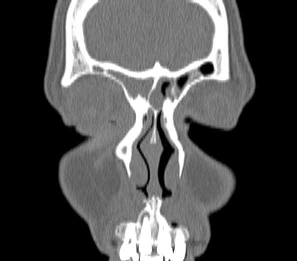 Acute sinusitis (Radiopaedia 40564-43158 Coronal bone window 4).jpg