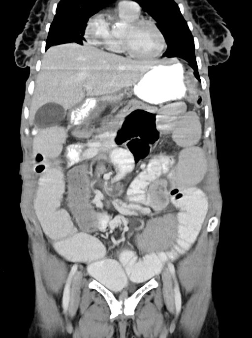 Acute small bowel (ileal) volvulus (Radiopaedia 71740-82139 Coronal C+ portal venous phase 41).jpg