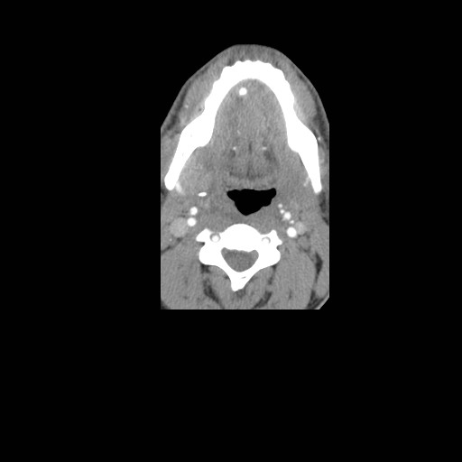 File:Acute submandibular sialadenitis secondary to ductal stone (Radiopaedia 27999-28267 Axial non-contrast 1).jpg