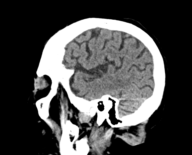 Acute traumatic subdural hematoma (Radiopaedia 82921-97257 Sagittal non-contrast 20).jpg