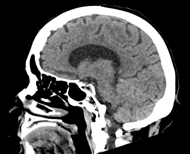 Acute traumatic subdural hematoma (Radiopaedia 82921-97257 Sagittal non-contrast 34).jpg