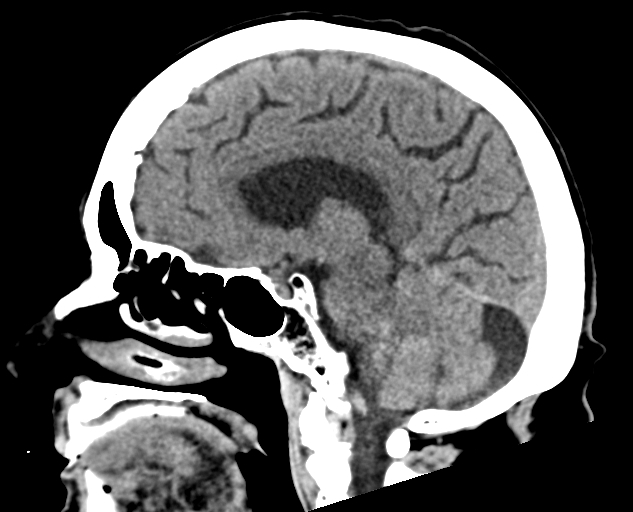 Acute traumatic subdural hematoma (Radiopaedia 82921-97257 Sagittal non-contrast 41).jpg
