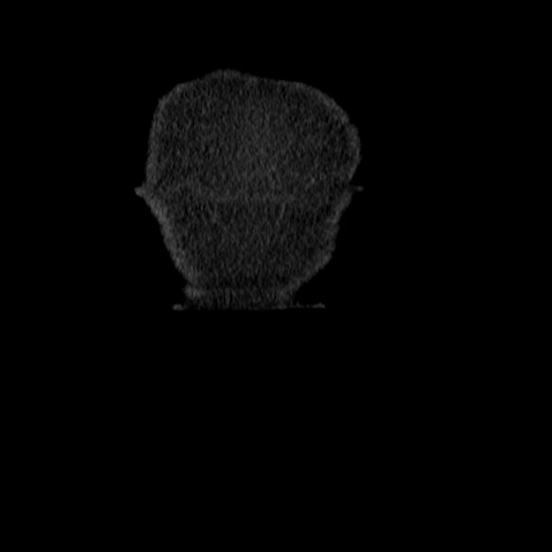 Acute tubular necrosis (Radiopaedia 28077-28334 D 4).jpg