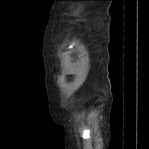 Acute tubular necrosis (Radiopaedia 28077-28334 Sagittal non-contrast 81).jpg