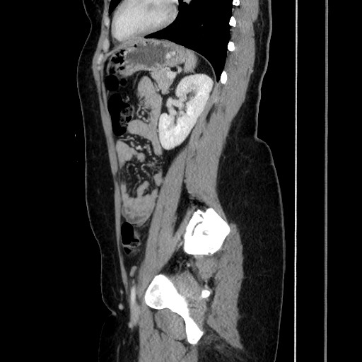 Acute uncomplicated appendicitis (Radiopaedia 73704-84499 Sagittal C+ portal venous phase 139).jpg