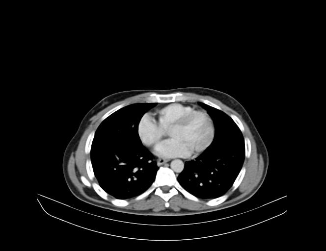 Addison disease (Radiopaedia 49318-54412 Axial C+ portal venous phase 20).jpg