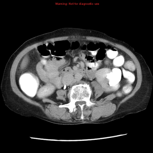 Adenocarcinoma of the colon (Radiopaedia 8191-9039 Axial renal excretory phase 24).jpg