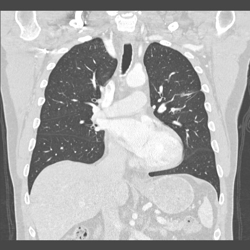 Adenocarcinoma of the lung (Radiopaedia 59871-67325 Coronal lung window 27).jpg