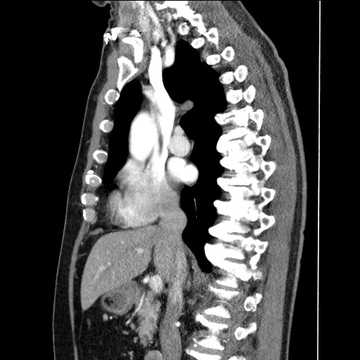 Adenocarcinoma of the lung (Radiopaedia 59871-67325 Sagittal C+ arterial phase 44).jpg
