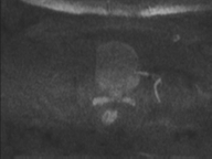 Adenocarcioma of rectum- T1 lesion (Radiopaedia 36921-38546 Axial DWI 73).png