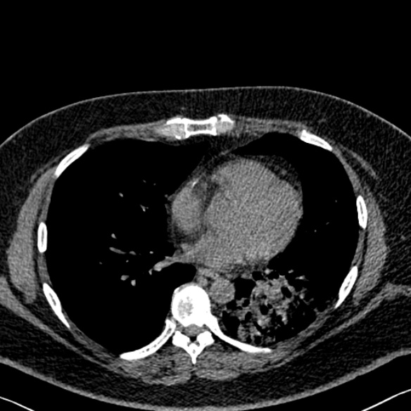 File:Adenoid cystic carcinoma of the trachea (Radiopaedia 49042-54137 Axial non-contrast 209).jpg