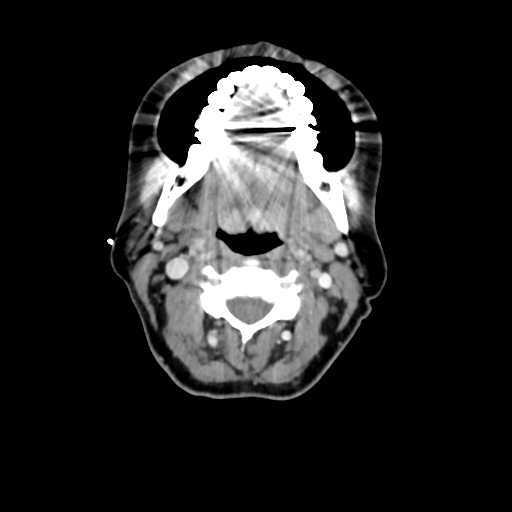 File:Adenoid cystic tumor of palate (Radiopaedia 46980-51518 Axial C+ delayed 36).png