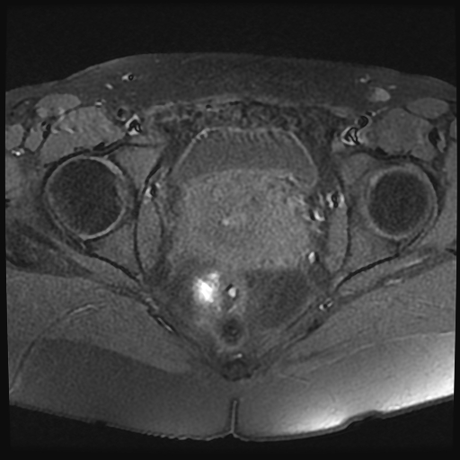 File:Adenomyosis-scar endometriosis (Radiopaedia 65863-75022 Axial T1 fat sat 20).jpg