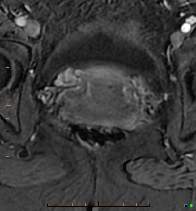 Adenomyosis uterus with hematometra (Radiopaedia 45779-50011 Axial T1 C+ fat sat 50).jpg
