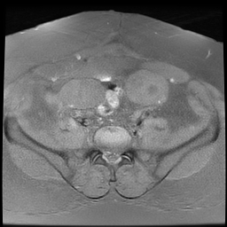 File:Adenomyosis within a didelphys uterus (Radiopaedia 70175-80215 Axial T1 fat sat 16).jpg