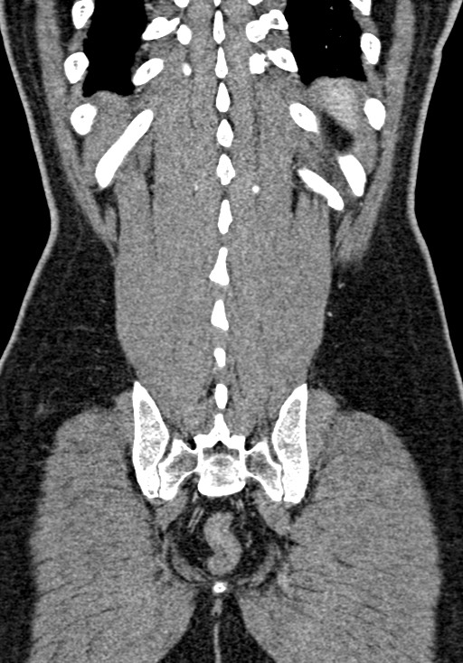 Adhesional small bowel obstruction (Radiopaedia 58900-66131 Coronal C+ portal venous phase 209).jpg