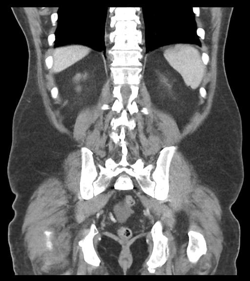 Adhesions within abdominal wall hernia (Radiopaedia 58283-65394 Coronal C+ portal venous phase 54).png