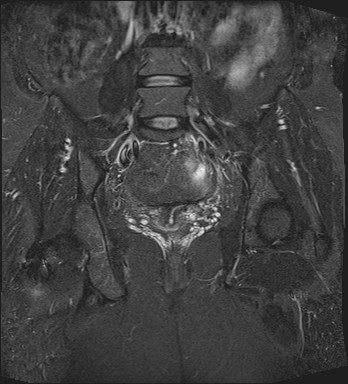 File:Adnexal multilocular cyst (O-RADS US 3- O-RADS MRI 3) (Radiopaedia 87426-103754 Coronal T2 fat sat 20).jpg