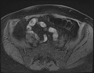 File:Adnexal multilocular cyst (O-RADS US 3. O-RADS MRI 3) (Radiopaedia 87426-103754 Axial 213).jpeg