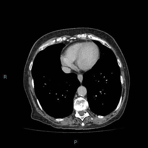 File:Adrenal collision tumor (ACT) (Radiopaedia 48462-53379 Axial C+ delayed 4).jpg