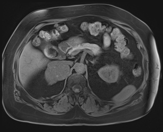 Adrenal cortical carcinoma (Radiopaedia 64017-72770 Axial T1 fat sat 31).jpg