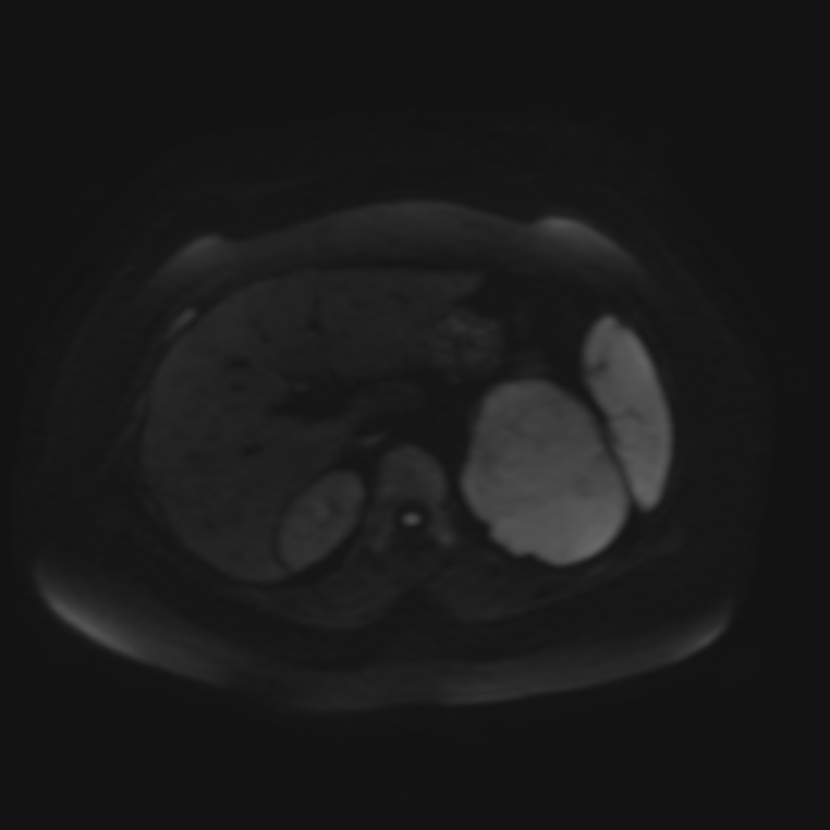 Adrenal cortical carcinoma (Radiopaedia 70906-81116 Axial DWI 38).jpg