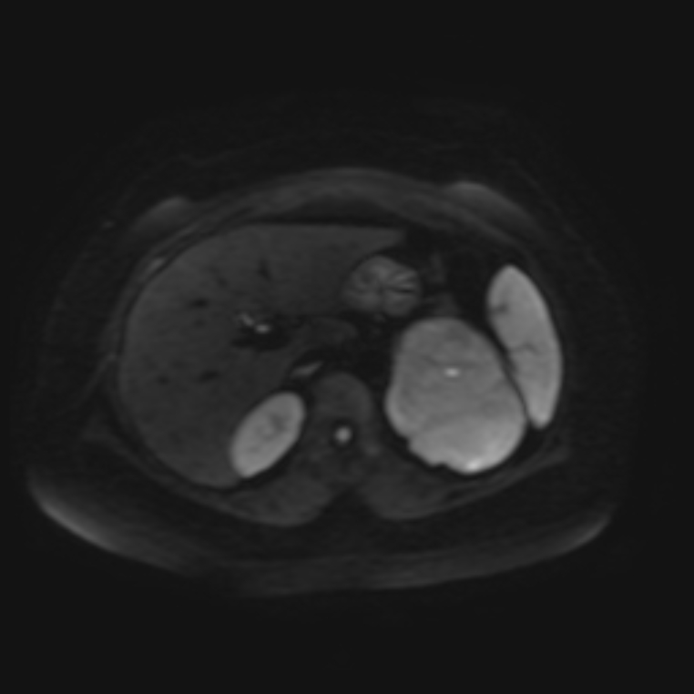 Adrenal cortical carcinoma (Radiopaedia 70906-81116 Axial DWI 9).jpg