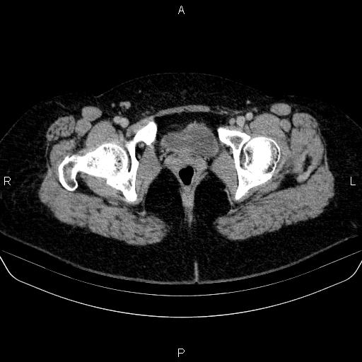 Adrenal cortical carcinoma (Radiopaedia 84882-100379 Axial C+ delayed 95).jpg