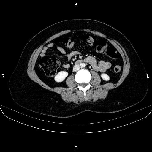 Adrenal cortical carcinoma (Radiopaedia 84882-100379 Axial C+ portal venous phase 48).jpg