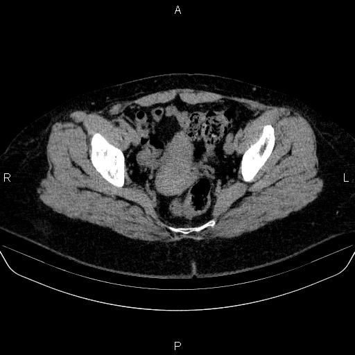 File:Adrenal cortical carcinoma (Radiopaedia 84882-100379 Axial non-contrast 85).jpg