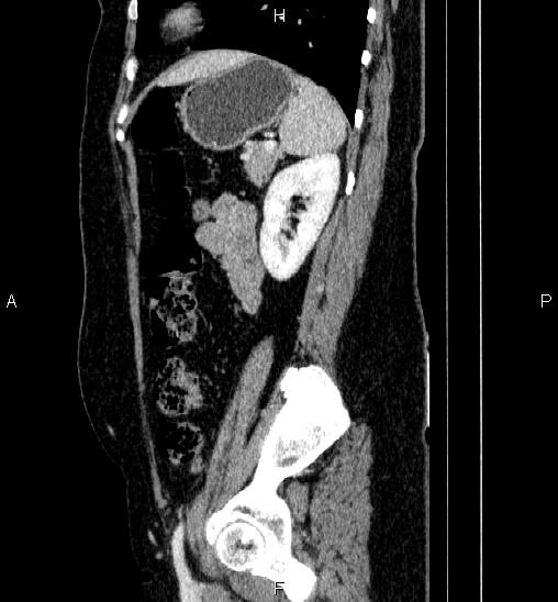 Adrenal cortical carcinoma (Radiopaedia 84882-100379 Sagittal C+ portal venous phase 66).jpg