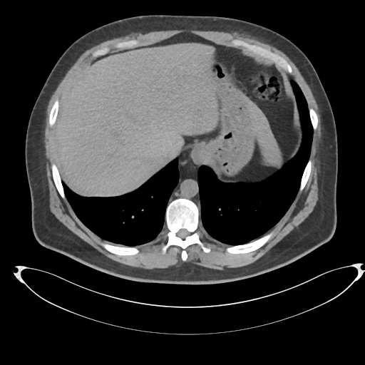 File:Adrenal cyst (Radiopaedia 45625-49778 Axial non-contrast 10).png