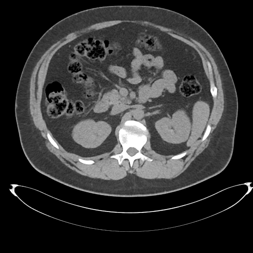 Adrenal cyst (Radiopaedia 45625-49778 Axial non-contrast 42).png