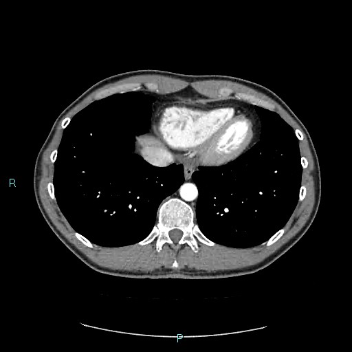 Adrenal cystic lymphangioma (Radiopaedia 83161-97534 Axial C+ arterial phase 10).jpg