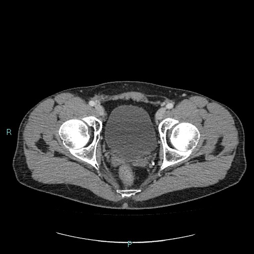Adrenal cystic lymphangioma (Radiopaedia 83161-97534 Axial C+ portal venous phase 93).jpg