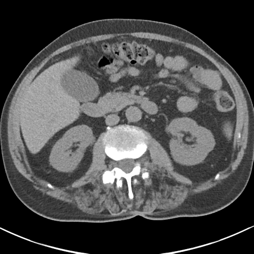 File:Adrenal hematoma (Radiopaedia 44334-47967 Axial non-contrast 44).png