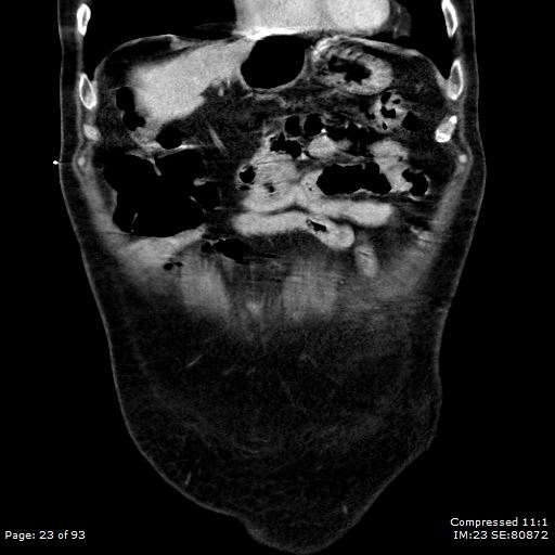 Adrenal metastasis (Radiopaedia 78425-91079 Sagittal C+ portal venous phase 10).jpg
