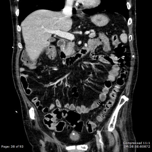 Adrenal metastasis (Radiopaedia 78425-91079 Sagittal C+ portal venous phase 25).jpg