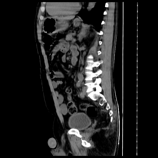 File:Adrenal myelolipoma (Radiopaedia 41843-44834 Sagittal non-contrast 24).jpg
