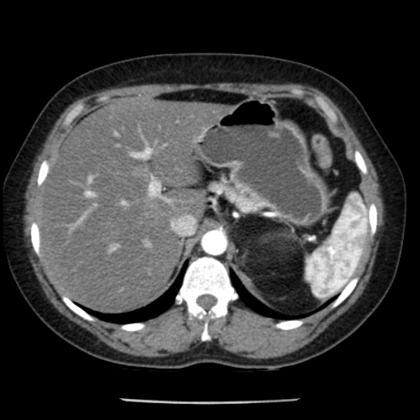 Adrenal myelolipoma (Radiopaedia 43401-46759 Axial C+ arterial phase 23).jpg