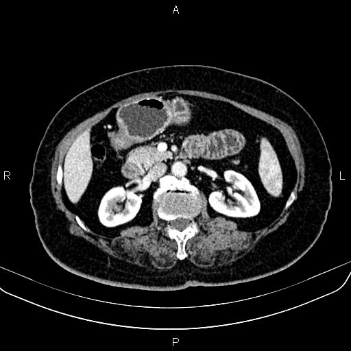 Adrenal myelolipoma (Radiopaedia 82742-96986 Axial renal cortical phase 73).jpg