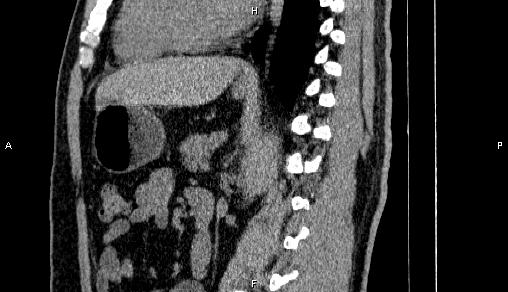 Adrenal myelolipoma (Radiopaedia 84321-99619 Sagittal non-contrast 63).jpg