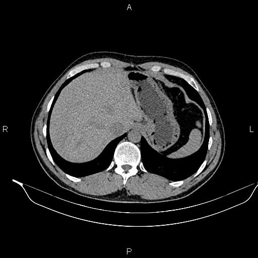 Adrenal myelolipoma (Radiopaedia 87794-104246 Axial non-contrast 19).jpg