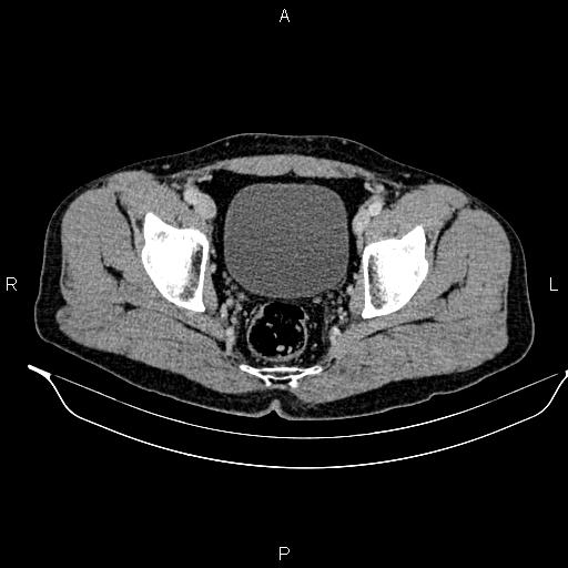 Adrenal myelolipoma (Radiopaedia 87794-104246 Axial renal cortical phase 97).jpg