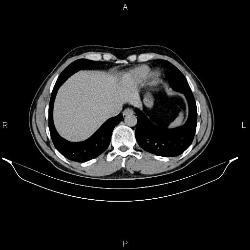 Adrenal myelolipoma (Radiopaedia 87794-104246 Axial renal excretory phase 12).jpg