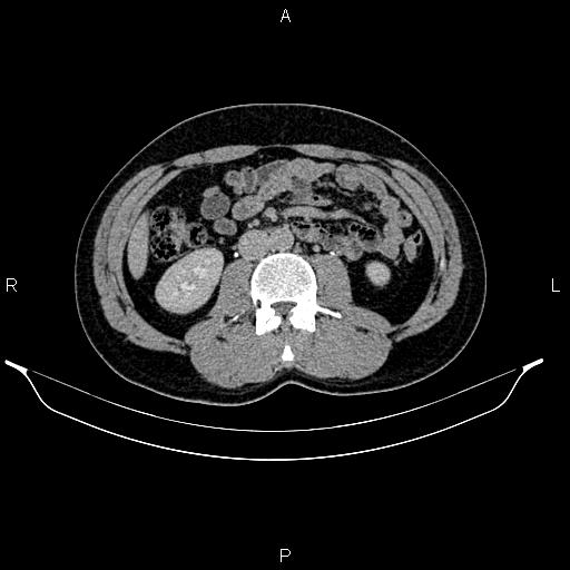 Adrenal myelolipoma (Radiopaedia 87794-104246 Axial renal excretory phase 51).jpg