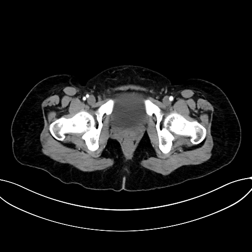 Adrenocortical carcinoma (Radiopaedia 87281-103569 Axial C+ arterial phase 87).jpg