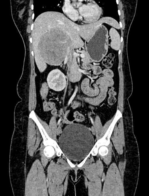 Adrenocortical carcinoma (Radiopaedia 87281-103569 Coronal C+ portal venous phase 31).jpg